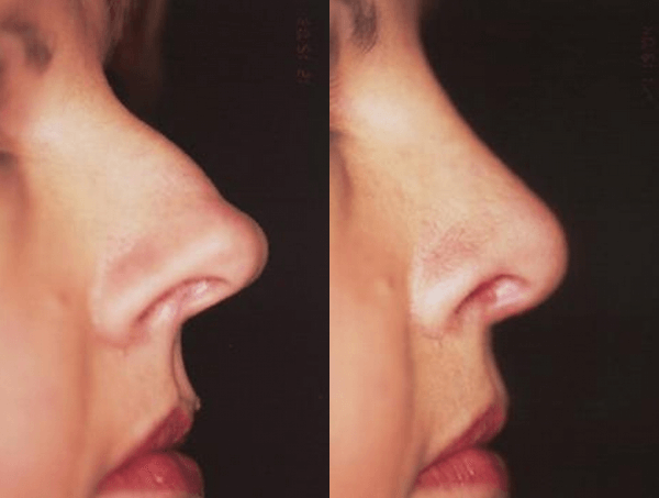 scottish nose shape