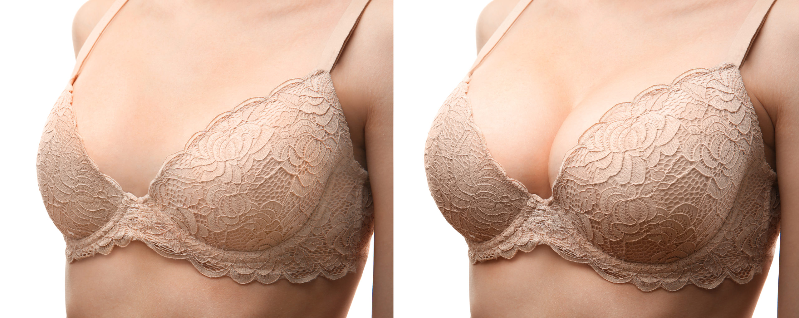What Can You NOT Do After Breast Augmentation?