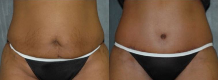 What's the difference between Liposuction and Tummy Tuck?